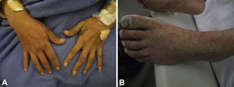 Staphylococcus aureus Bacteremia Masquerading as Leukocytoclastic ...