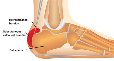 Achilles Bursitis | Retrocalcaneal Bursitis - Symptoms, Causes & Treatment