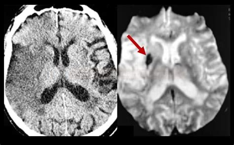 Acute stroke complications | STROKE MANUAL