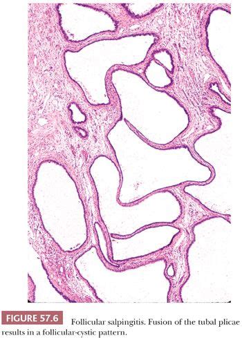 Fallopian Tube and Broad Ligament | Basicmedical Key