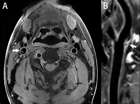 Frontiers | The carotid web: Current research status and imaging features