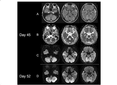 Brain MRIs obtained during the acute stage of cerebellar stroke-like... | Download Scientific ...