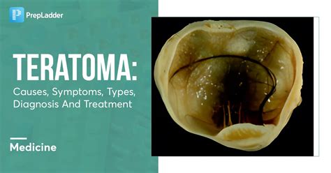 Teratoma: Causes, Symptoms, Types, Diagnosis And Treatment.