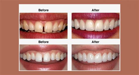 Prosthodontics & Veneer Correction in Kerala | Dental Implants ...