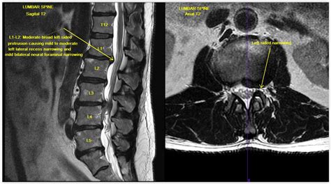 Lumbar Disc Disease Mri