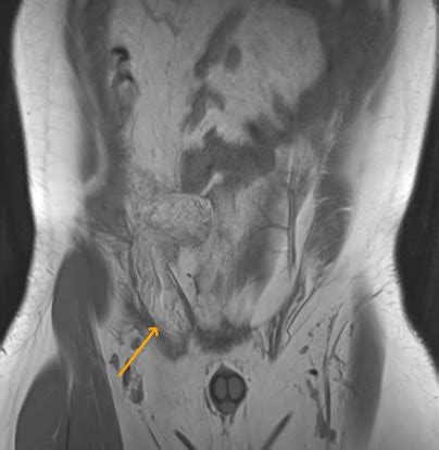 mricases: Right inguinal hernia