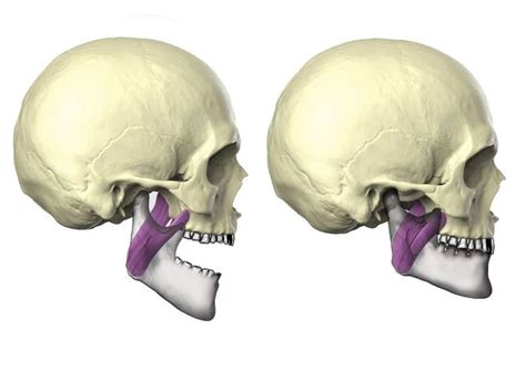 Medial Pterygoid muscle - Origin, Insertion, Function, Exercise