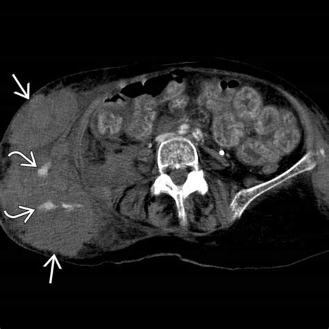 Traumatic Abdominal Wall Hernia | Radiology Key