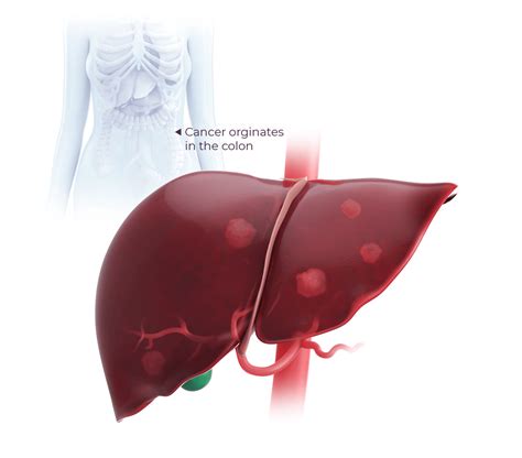 Colorectal Cancer with Liver Metastases Treatment Approach