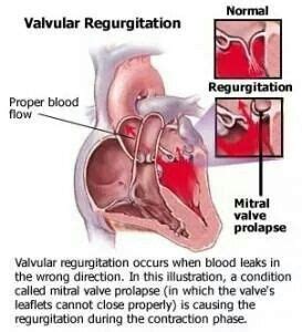 Valvular regurgitation | Heart valves, Mitral valve prolapse, Cardiac nursing