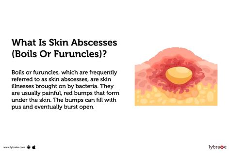 Skin Abscesses (Boils Or Furuncles): Causes, Symptoms, Treatment And Cost