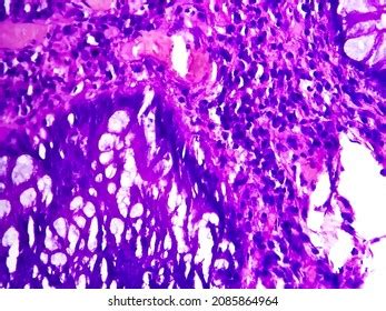 Benign Hyperplastic Polyp Colon Notice Typical Stock Photo 2085864964 ...