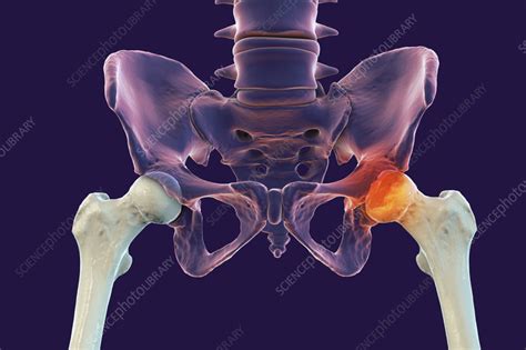 Legg-Calve-Perthes disease, illustration - Stock Image - F037/6850 ...