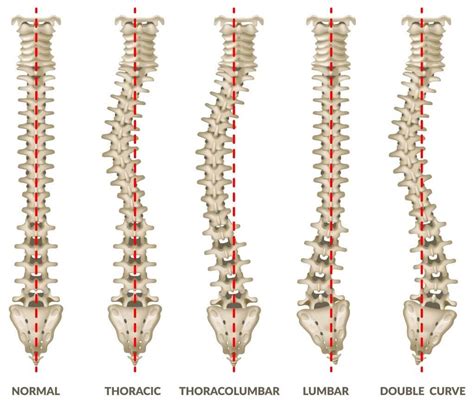 What Are The Different Types of Scoliosis? | Rolling Hills Medical