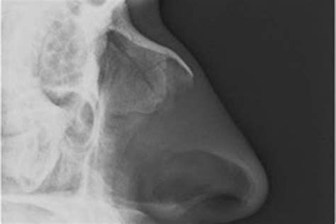 Nasal Fractures: What does the literature say? - Godoy Medical Forensics