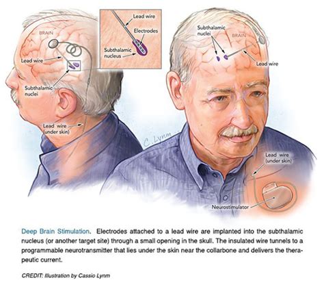 Deep brain stimulation for Parkinson’s disease - Lasker Foundation