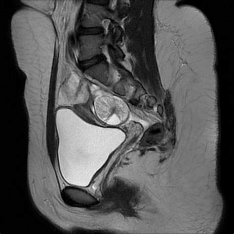 Ovarian dermoid cyst | Image | Radiopaedia.org