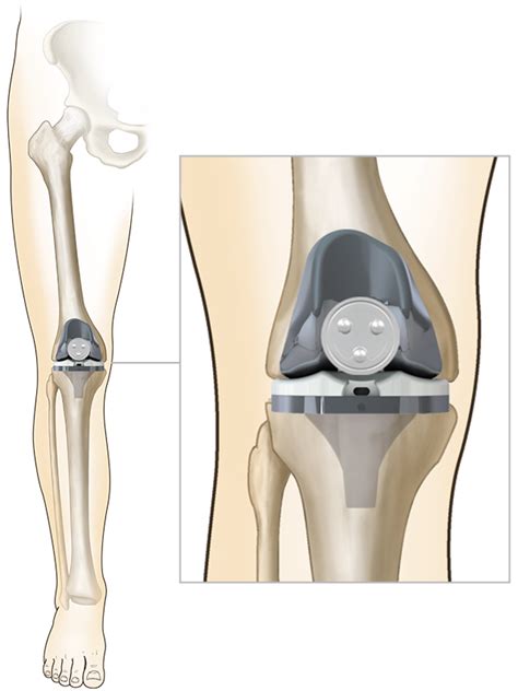 Total Knee Replacement - exac.com.au