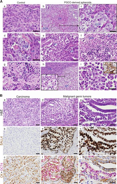 Formation of germ cell tumors and carcinomas of different grades from... | Download Scientific ...