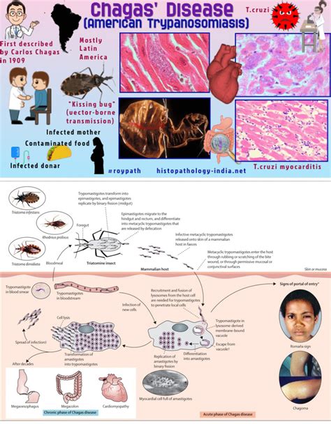 Sthanu on Twitter: "@AaronGoodman33 Chagas disease American trypanosomiasis Trypanosoma cruzi 45 ...