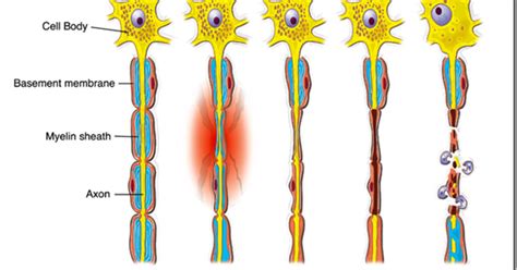 What is Neuropraxia - Definition, Symptoms, Causes, Treatment - Health Care Tips and Natural ...