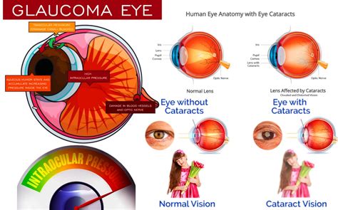 Glaucoms Intraocular Pressure IOP Homeopathic Treatement ,Glaucoma ...