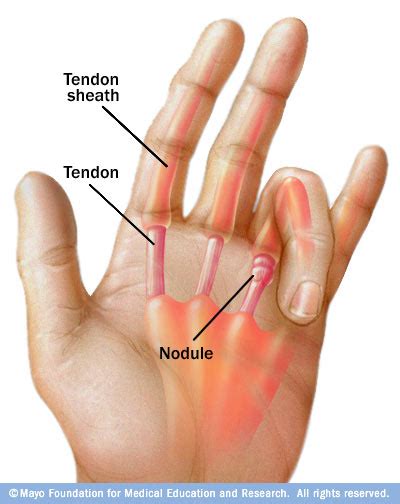 Hand / Finger Tendinitis | 👨‍⚕️Singapore Orthopaedic & Neurosurgery Clinic