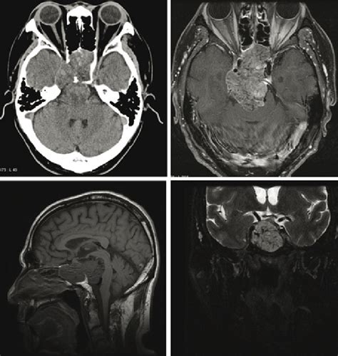 CT and MRI demonstrate a large destructive soft tissue mass arising... | Download Scientific Diagram