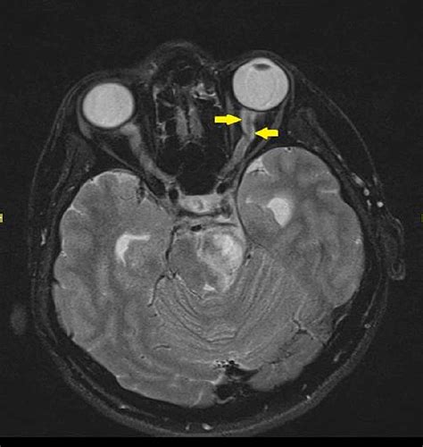 Cureus | Optic Perineuritis in Neuromyelitis Optica Spectrum Disorder