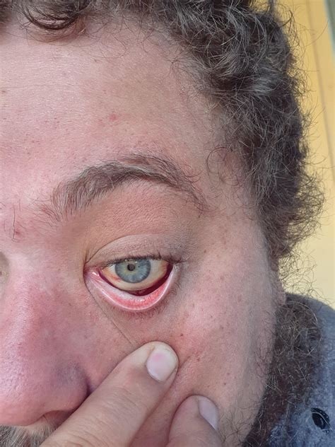 I'm an alcoholic and i think i have damaged my eye : AskDocs