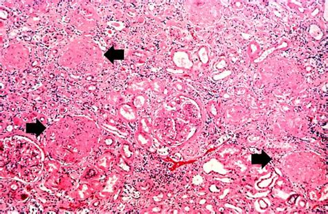 Glomerulonephritis pathophysiology - wikidoc