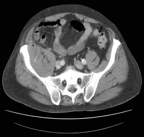 CT scan of the abdomen showing an appendix mass with a small abscess... | Download Scientific ...