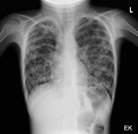 Cystic fibrosis | Radiology Reference Article | Radiopaedia.org