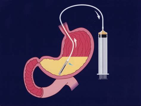 Monitoring for Intolerance to Gastric Tube Feedings - Off the Charts