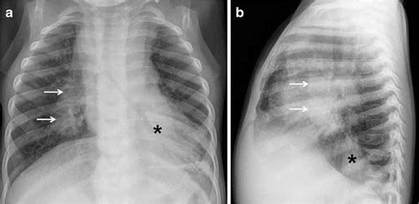 Ghon complex, ghon focus, definition, chest x-ray & causes