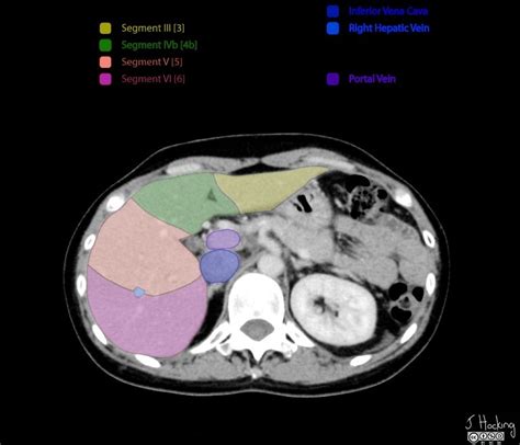 Liver segments: annotated CT | Radiology Case | Radiopaedia.org | Liver anatomy, Radiology ...