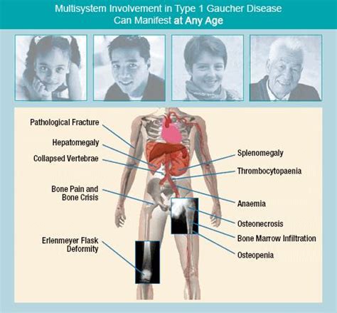 Gaucher Disease - Physiopedia