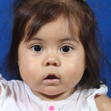 Pierre Robin Sequence Gallery - Dell Children's Craniofacial Team of Texas