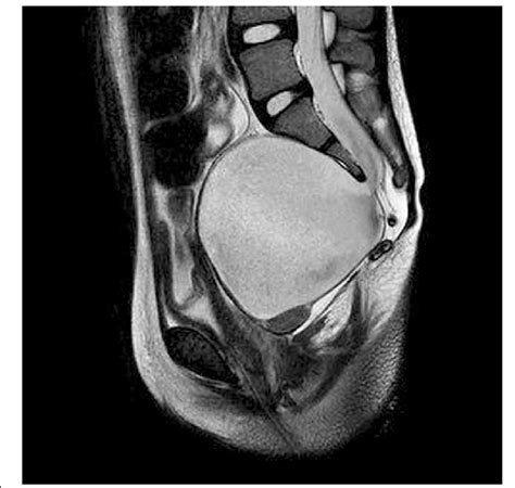 T2W MRI sagittal image showing anterior sacral meningocele (8.1 × 8.1 ×... | Download Scientific ...