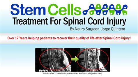 Treatment for Spinal Cord Injury with Stem Cells Therapy - YouTube