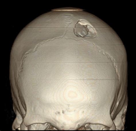 Traumatismo Craneal (TCE): Hemorragias intra y extraaxiales, Lesión Axonal Difusa y Lesiones ...