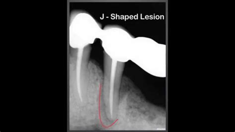 Vertical Root Fracture - Tooth Autopsy - YouTube