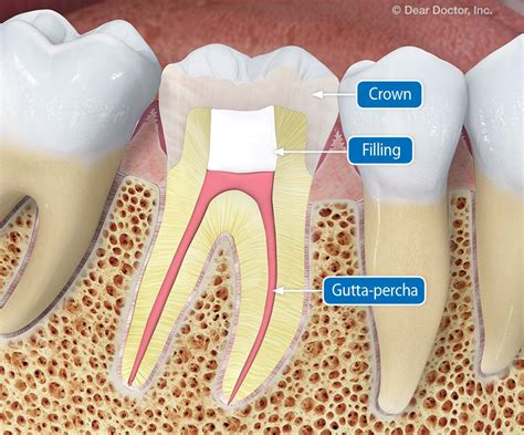 How To Tell If You Need A Root Canal After A Crown - What Is A Root Canal? | Wilson Martino ...