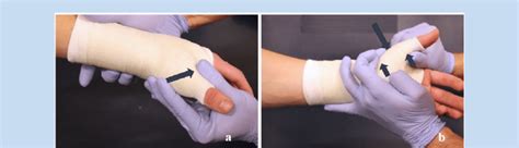 Thumb spica cast molding positions. Note: Size of arrows indicates... | Download Scientific Diagram