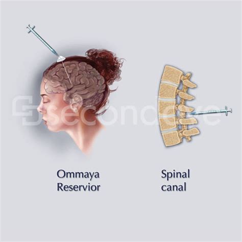 Intrathecal Injection | An Illustration for an interactive t… | Flickr