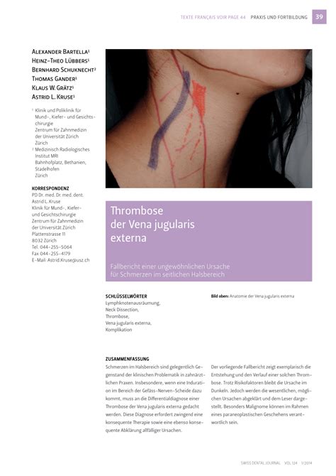 (PDF) Thrombosis of the external jugular vein. Case report of a rare cause for pain in the ...