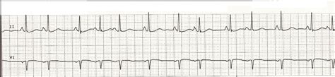 Float Nurse: EKG Rhythm Strips 59