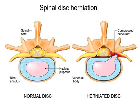 Lower Back Pain & The Herniated Disc