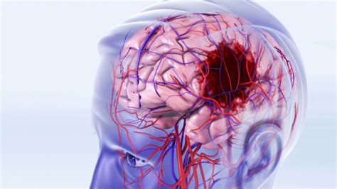 Stroke Prevention Animation - CAST PHARMA