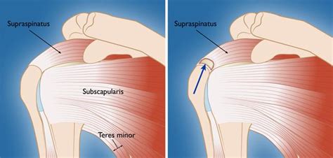 Rotator Cuff Tears - OrthoInfo - AAOS